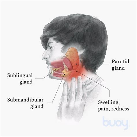 blocked prada gland|parotid duct blockage.